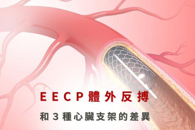 EECP體外反搏治療，與3種心臟支架治療方式的差異，幫助改善心血管健康。